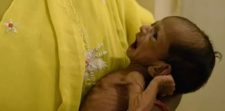 गुजरात मॉडल : बच्चों में कुपोषण की समस्या ज्यों की त्यों