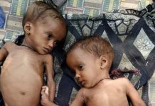 भारत में 14 लाख से अधिक बच्चे गंभीर रूप से कुपोषित